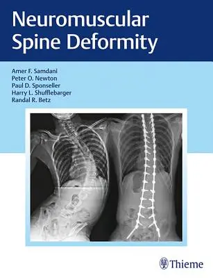 Neuromuskulární deformace páteře - Neuromuscular Spine Deformity