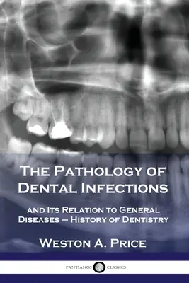 The Pathology of Dental Infections: and Its Relation to General Diseases - History of Dentistry (Patologie zubních infekcí a její vztah k celkovým onemocněním) - The Pathology of Dental Infections: and Its Relation to General Diseases - History of Dentistry