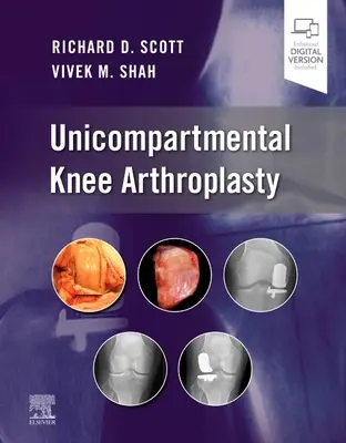 Unikompartmentální artroplastika kolenního kloubu - Unicompartmental Knee Arthroplasty