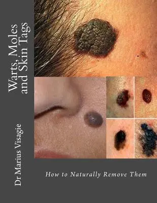 Bradavice, mateřská znaménka a kožní značky: Jak je přirozeně odstranit? - Warts, Moles and Skin Tags: How to Naturally Remove Them