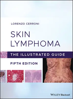 Kožní lymfom: Ilustrovaný průvodce - Skin Lymphoma: The Illustrated Guide