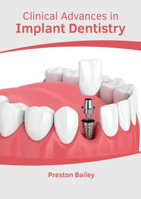Klinické pokroky v implantologické stomatologii - Clinical Advances in Implant Dentistry
