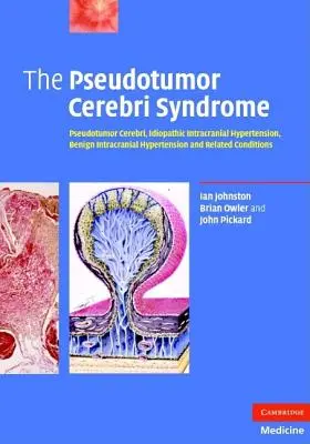 Syndrom pseudotumor cerebri - The Pseudotumor Cerebri Syndrome