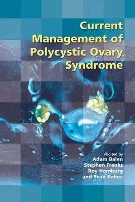 Současný management syndromu polycystických vaječníků - Current Management of Polycystic Ovary Syndrome