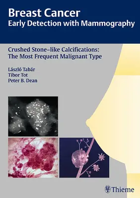 Rakovina prsu: Včasná detekce pomocí mamografie: Crushed Stone-Like Calcifications (Kalcifikace podobné rozdrceným kamenům): Nejčastější maligní typ [s CDROM] - Breast Cancer: Early Detection with Mammography: Crushed Stone-Like Calcifications: The Most Frequent Malignant Type [With CDROM]